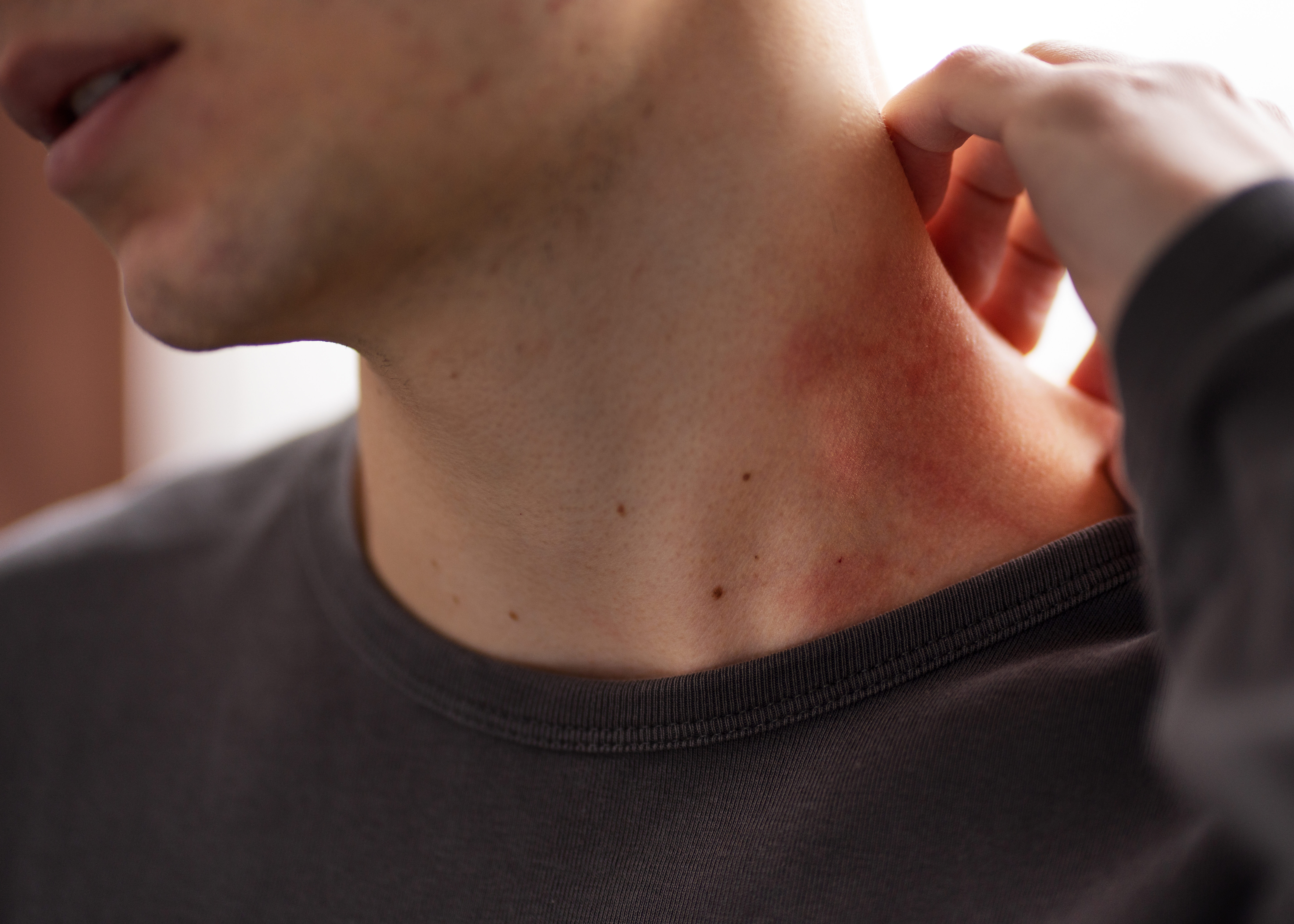Homme se grattant le cou en raison de problèmes cutanés ou irritation de la peau